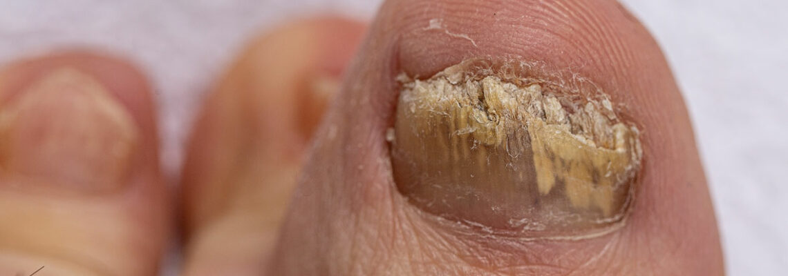 mycose des ongles